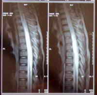 MRI-Aufnahme des Rückenmarks
