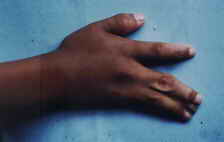 Kadeks rechte Hand vor der Operation: Mittlerer und Kleiner Finger sind zusammengewachsen; vom Ringfinger gibt es nur den Nagel.